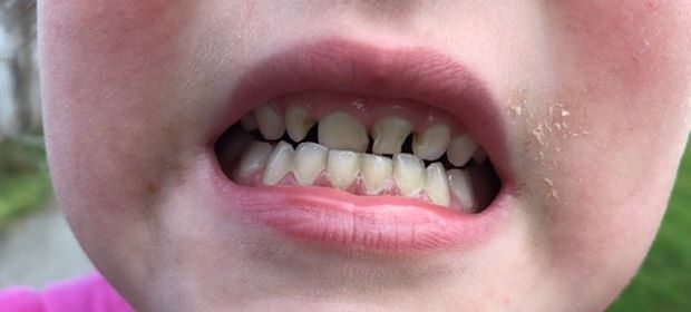 Dental problems in children!